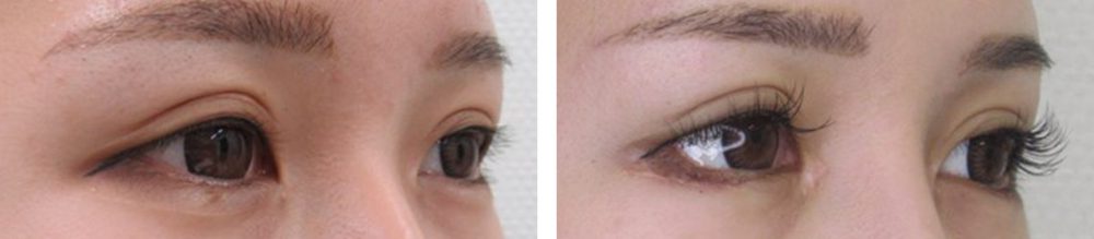 目尻靭帯移動術/グラマラスライン（タレ目形成）/目頭切開術の症例写真 施術前後 １ヵ月