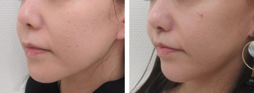 人中短縮術(リップリフト)・外側人中短縮術/TAC式 鼻翼縮小術（小鼻縮小）/鼻翼挙上術の症例写真 施術前後 １ヵ月