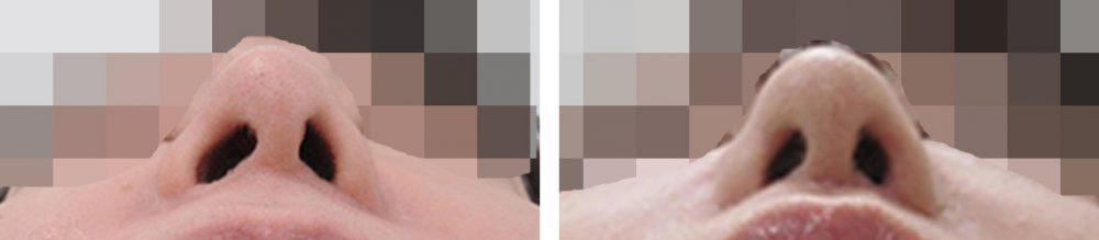 人中短縮術(リップリフト)・外側人中短縮術/TAC式 鼻翼縮小術（小鼻縮小）/鼻翼挙上術の症例写真 施術前後 １ヵ月