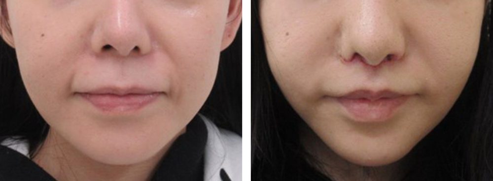 人中短縮術(リップリフト)・外側人中短縮術/TAC式 鼻翼縮小術（小鼻縮小）/鼻翼挙上術の症例写真 施術前後 １週間