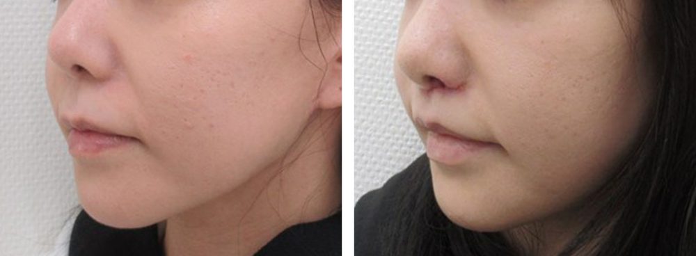 人中短縮術(リップリフト)・外側人中短縮術/TAC式 鼻翼縮小術（小鼻縮小）/鼻翼挙上術の症例写真 施術前後 １週間