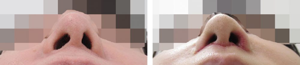 人中短縮術(リップリフト)・外側人中短縮術/TAC式 鼻翼縮小術（小鼻縮小）/鼻翼挙上術の症例写真 施術前後 １週間