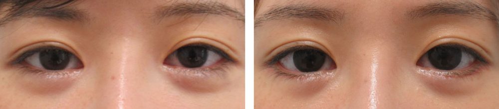 グラマラスライン（タレ目形成）の症例写真 施術前後 １ヵ月