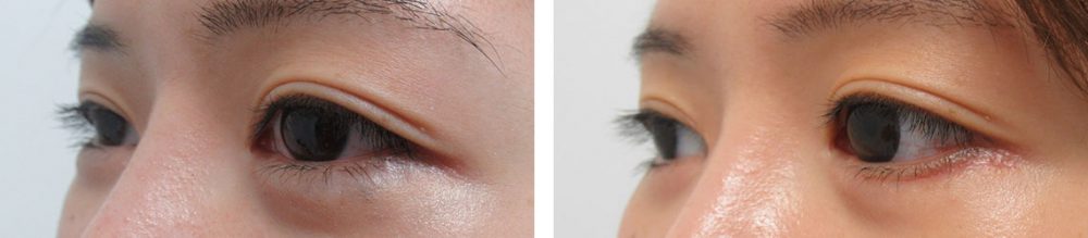 グラマラスライン（タレ目形成）の症例写真 施術前後 １ヵ月