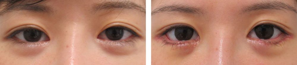 グラマラスライン（タレ目形成）の症例写真 施術前後 １週間