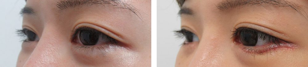 グラマラスライン（タレ目形成）の症例写真 施術前後 １週間