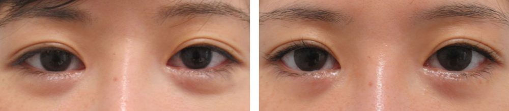 グラマラス切開で目を大きくタレ目に見せる