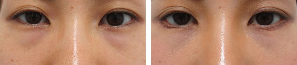 目尻靭帯移動術/グラマラスライン(タレ目形成)/下眼瞼脱脂術(目の下のたるみ取り・目の下の脂肪ふくらみ取り)の症例写真 施術前後 1ヵ月