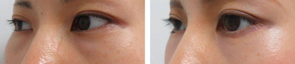 目尻靭帯移動術/グラマラスライン(タレ目形成)/下眼瞼脱脂術(目の下のたるみ取り・目の下の脂肪ふくらみ取り)の症例写真 施術前後 1ヵ月