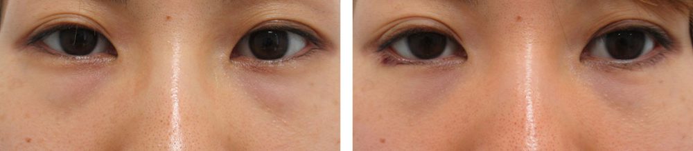 目尻靭帯移動術/グラマラスライン(タレ目形成)/下眼瞼脱脂術(目の下のたるみ取り・目の下の脂肪ふくらみ取り)の症例写真 施術前後 2ヵ月