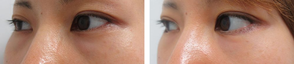 目尻靭帯移動術/グラマラスライン(タレ目形成)/下眼瞼脱脂術(目の下のたるみ取り・目の下の脂肪ふくらみ取り)の症例写真 施術前後 2ヵ月