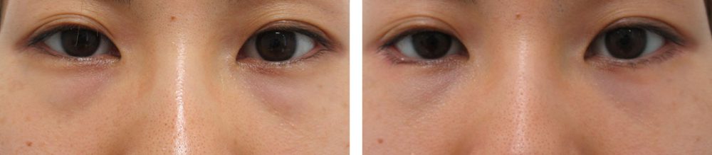 目元の複合施術で印象を変える