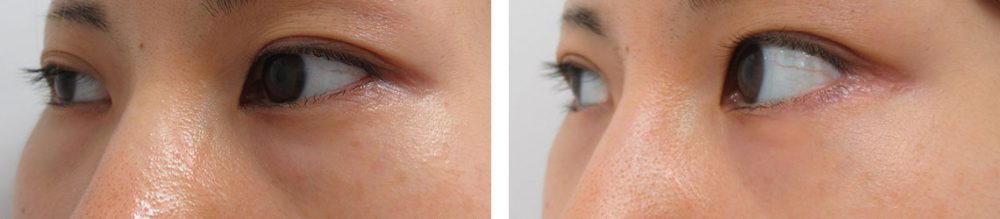 目尻靭帯移動術/グラマラスライン(タレ目形成)/下眼瞼脱脂術(目の下のたるみ取り・目の下の脂肪ふくらみ取り)の症例写真 施術前後 3ヵ月