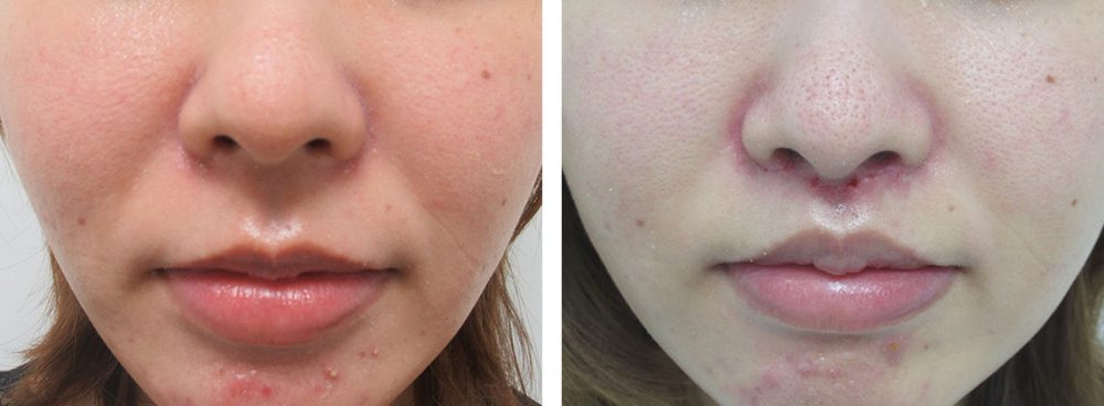 術後のケアで傷跡は目立ちにくくなります