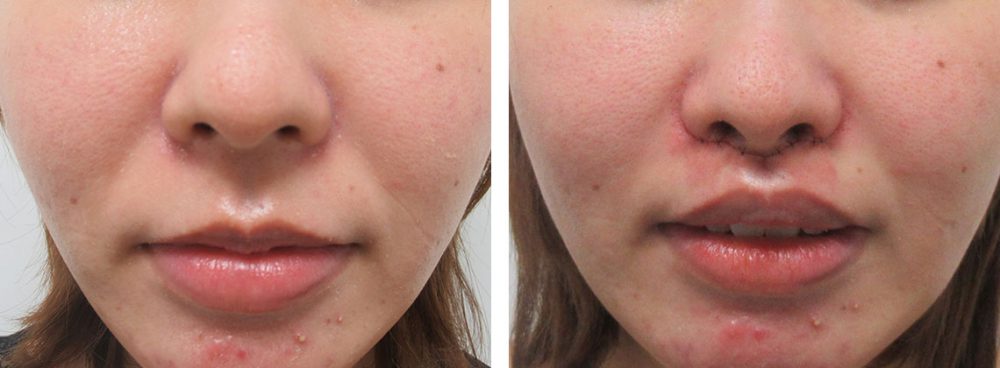 人中短縮術(リップリフト)・外側人中短縮術の症例写真 施術前後 直後