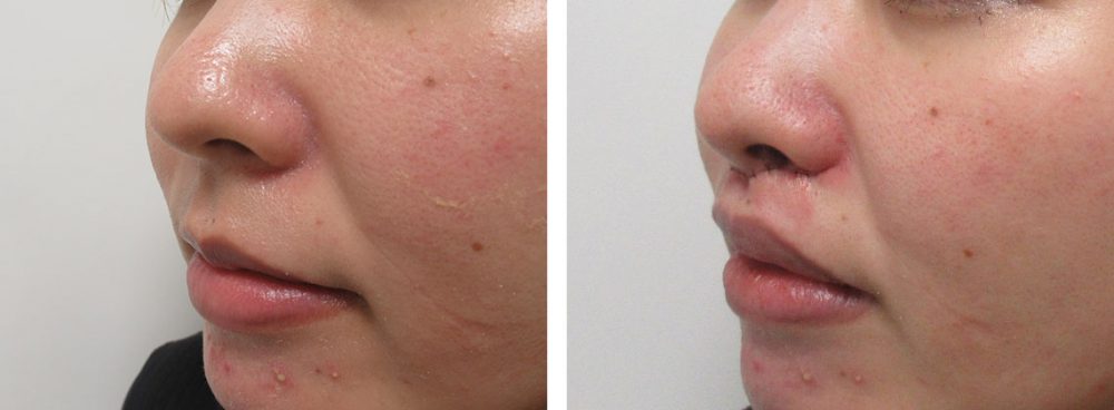 人中短縮術(リップリフト)・外側人中短縮術の症例写真 施術前後 直後