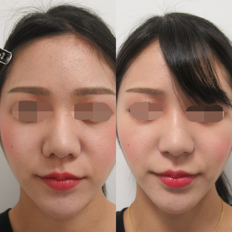 整形ブログ 画像 値段 鼻 小鼻や鼻孔に注目 Taクリニック 美容整形 美容外科