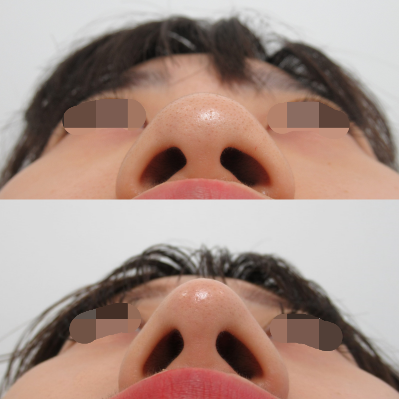 お鼻の複合施術の一か月経過
