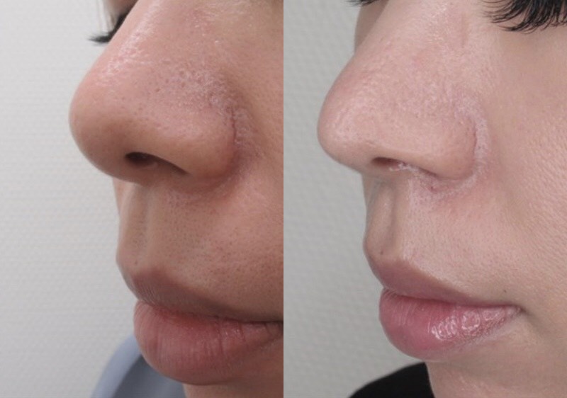 整形ブログ 画像 値段 鼻 小鼻や鼻孔に注目 Taクリニックグループ 美容整形 美容外科 全国展開中
