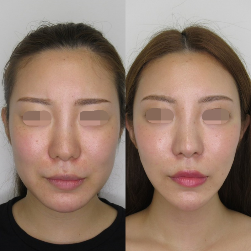 整形ブログ 画像 値段 鼻 鼻尖に特化 Taクリニック 美容整形 美容外科