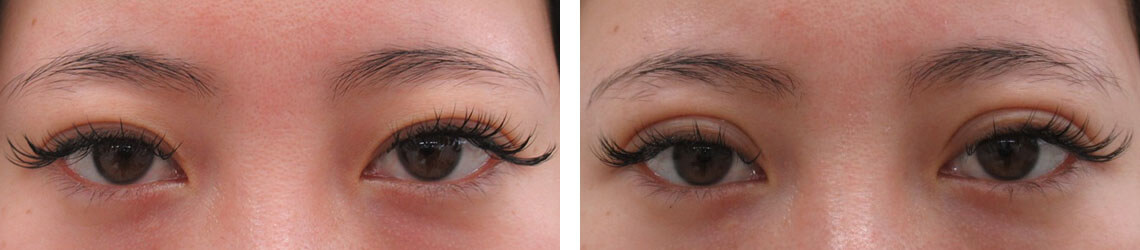 の症例写真 施術前後 １週間