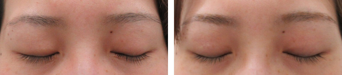 の症例写真 施術前後 １ヵ月