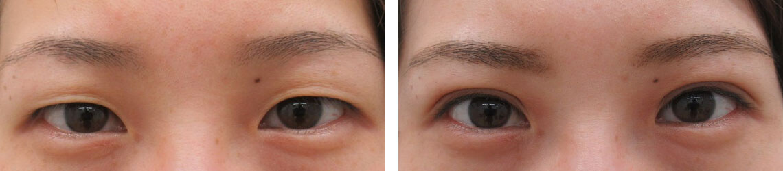 の症例写真 施術前後 １週間