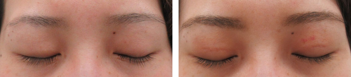 の症例写真 施術前後 １週間