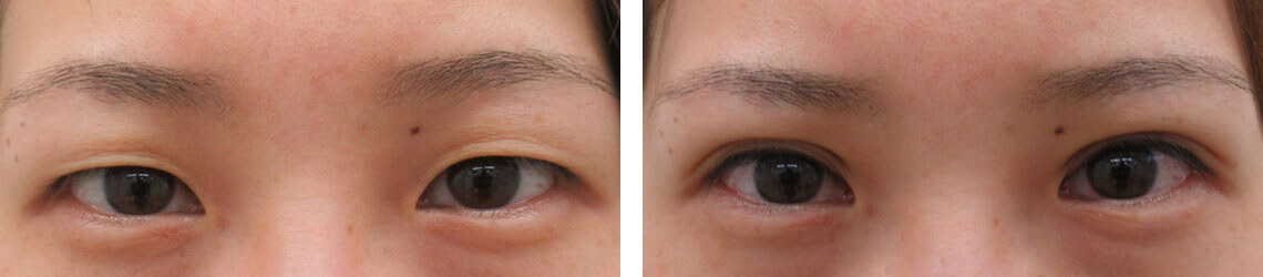 の症例写真 施術前後 直後