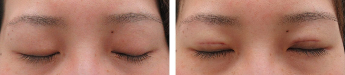 の症例写真 施術前後 直後