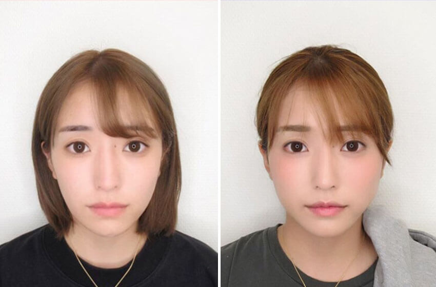 TAC式ツヤ肌コラーゲンリフトとバッカルファット除去の組み合わせ技です