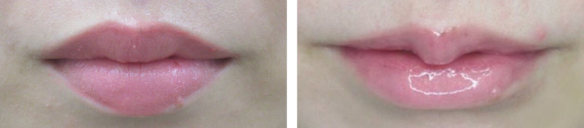口唇縮小術/M字リップ形成術の症例写真 施術前後 ２週間