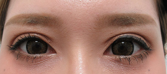 症例写真 ダウンタイム 眼瞼下垂の施術で目力がアップしました Taクリニック 美容整形 美容外科 新宿 銀座 横浜 大阪 福岡 川越 高崎 Taクリニック 美容整形 美容外科