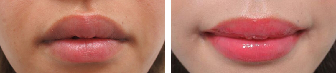 口角リフトでいつでも好印象に