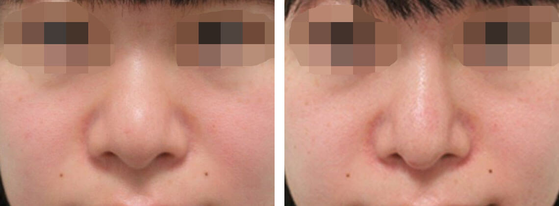 隆鼻術(プロテーゼ・自家組織)/鼻中隔延長術の症例写真 施術前後 1ヵ月