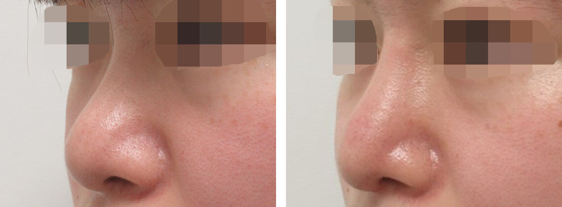 鼻中隔延長術と隆鼻術プロテーゼで鼻先に長さを出しました