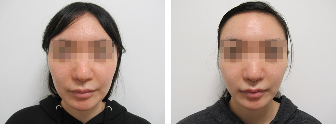 ２０代のバッカルファットのたるみを解消