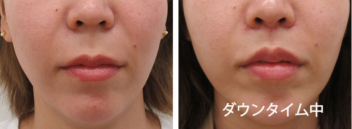 人中短縮術(リップリフト)・外側人中短縮術の症例写真 施術前後 1ヵ月