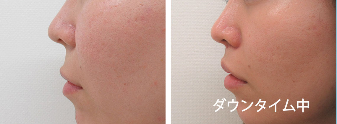 人中短縮術(リップリフト)・外側人中短縮術の症例写真 施術前後 1ヵ月