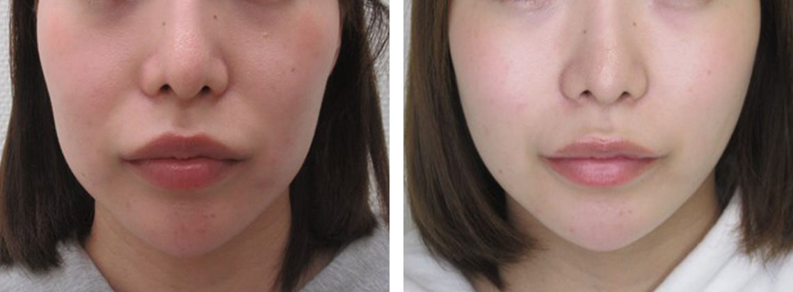 滑らかなフェイスラインに変化