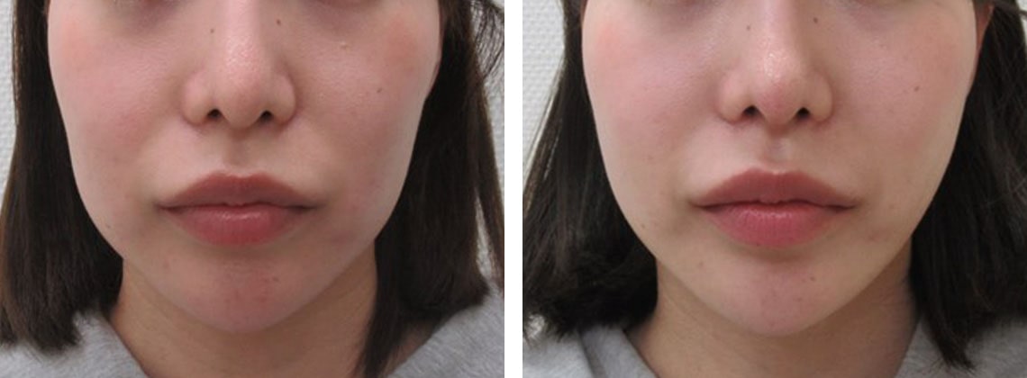 TAC式 ツヤ肌コラーゲンリフト®の症例写真 施術前後 １週間
