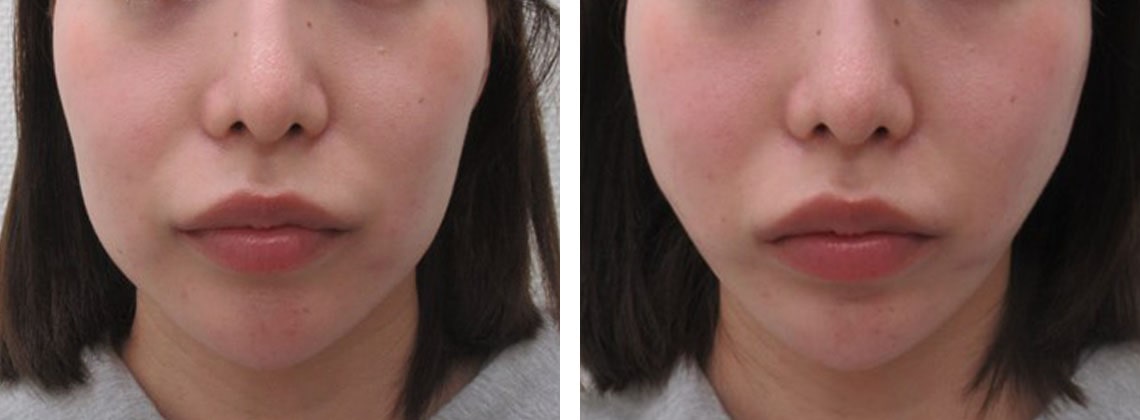 TAC式 ツヤ肌コラーゲンリフト®の症例写真 施術前後 直後