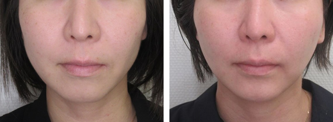 頬のたるみを改善し整ったフェイスラインに