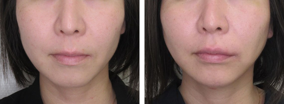 TAC式 ツヤ肌コラーゲンリフト®/バッカルファット除去/エラボトックス注射の症例写真 施術前後 １週間