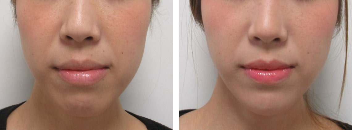 TAC式ツヤ肌コラーゲンリフトで輪郭の凹凸を改善