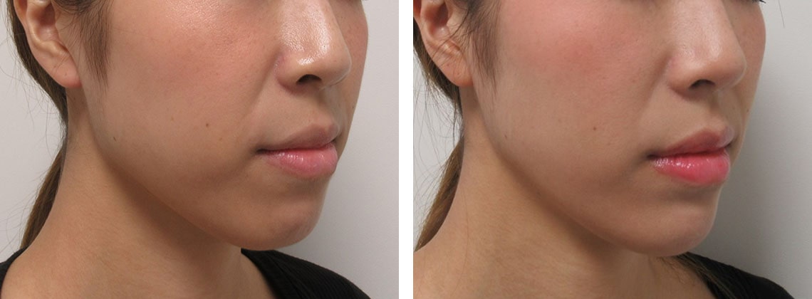 TAC式 ツヤ肌コラーゲンリフト®の症例写真 施術前後 １ヵ月