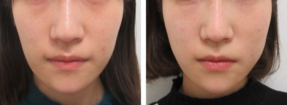 面長からタマゴ型に変化しました