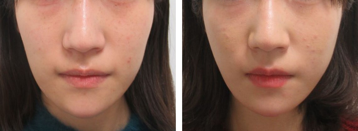 TAC式 ツヤ肌コラーゲンリフト®の症例写真 施術前後 １週間
