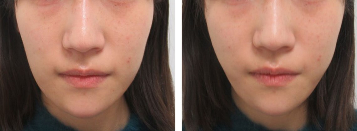 TAC式 ツヤ肌コラーゲンリフト®の症例写真 施術前後 直後
