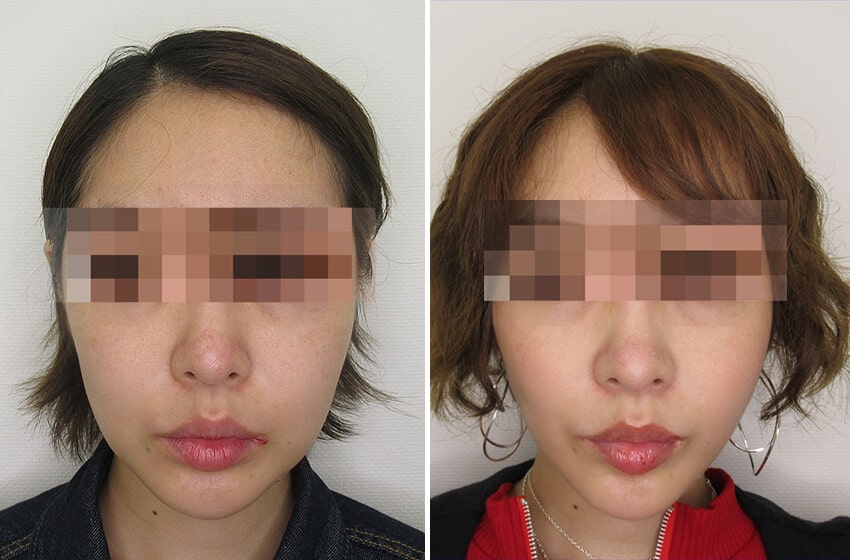 TAC式糸リフトとバッカルファット除去の組み合わせです